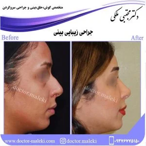 ریسک های جراحی زیبایی بینی
