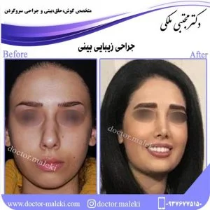 ریسک های جراحی زیبایی بینی