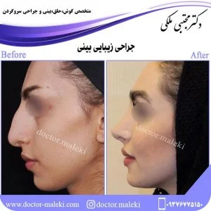 ریسک های جراحی زیبایی بینی