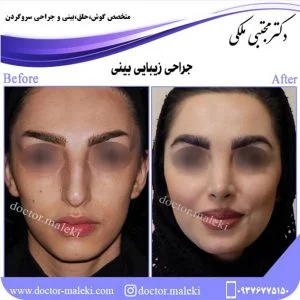 ریسک های جراحی زیبایی بینی