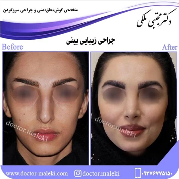 ریسک های جراحی زیبایی بینی
