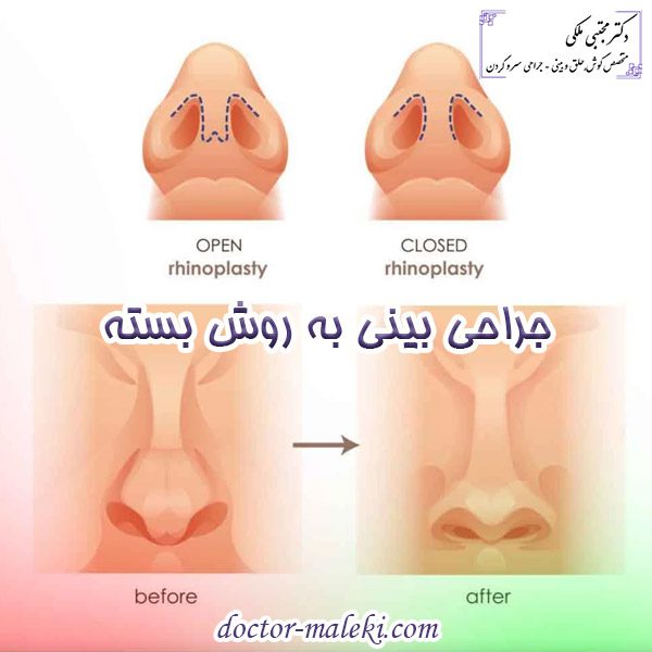 جراحی بینی به روش بسته چگونه است و چه مزایایی دارد ؟