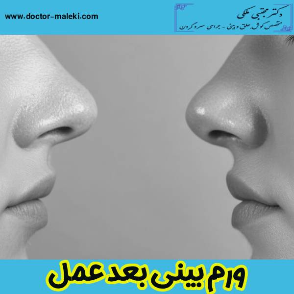 ورم بینی بعد از عمل تا کی ادامه دارد ؟