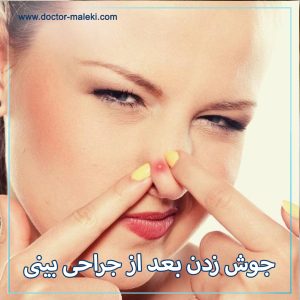 جوش زدن بعد از جراحی بینی