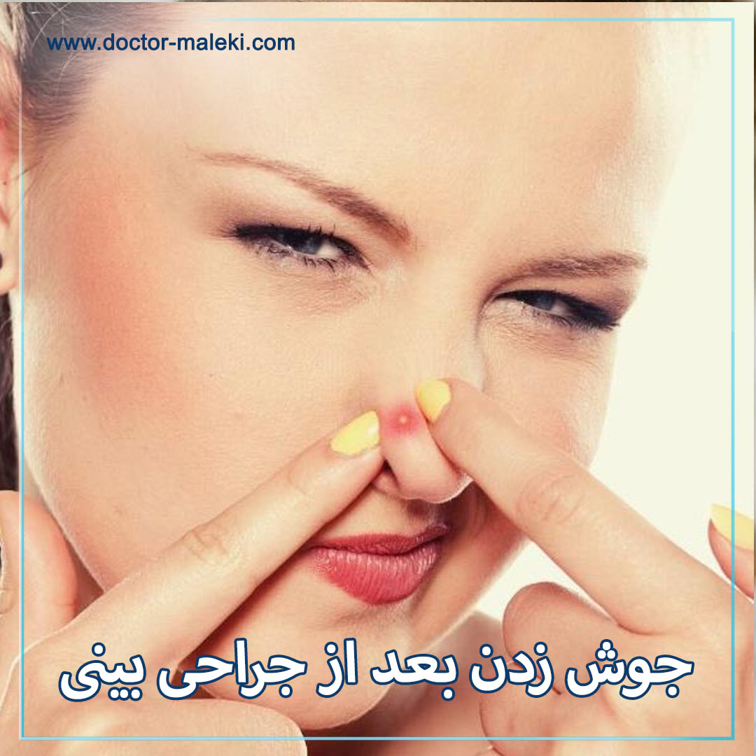 جوش زدن بعد از جراحی بینی