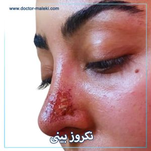نکروز بینی
