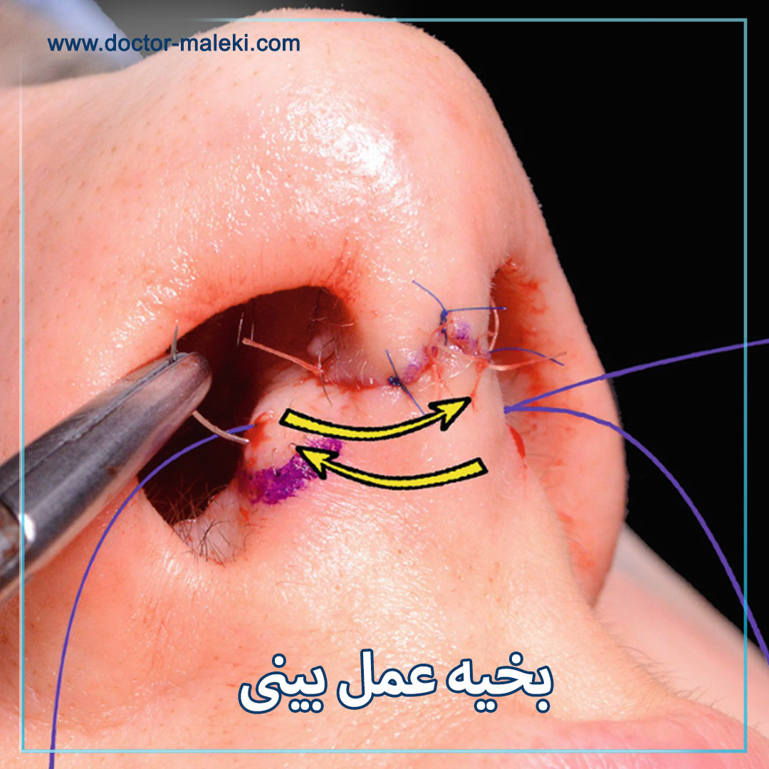 بخیه عمل بینی